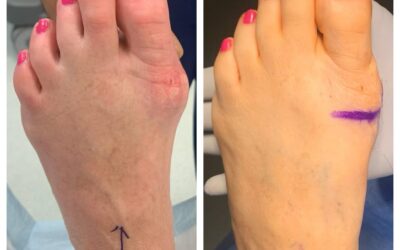 Minimally Invasive Bunion Surgery at Insight Orthopedics & Sports Medicine