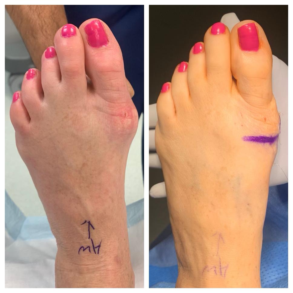 Minimally Invasive Bunion Surgery at Insight Orthopedics & Sports Medicine iinn