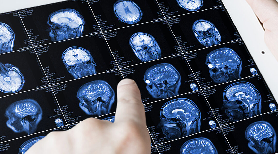 Understanding Signs and Symptoms of Brain Tumors – Insight Neurosurgery