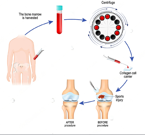 Benefits Of Stem Cell Therapy For Sports Injuries