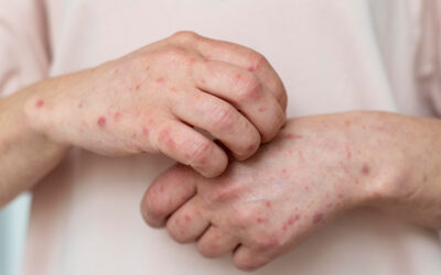 5 Fast At-Home Fixes for Eczema Flare Ups
