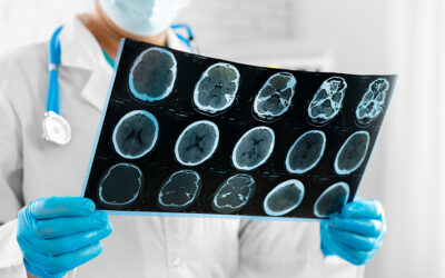 5 Warning Signs You Might Have a Brain Tumor